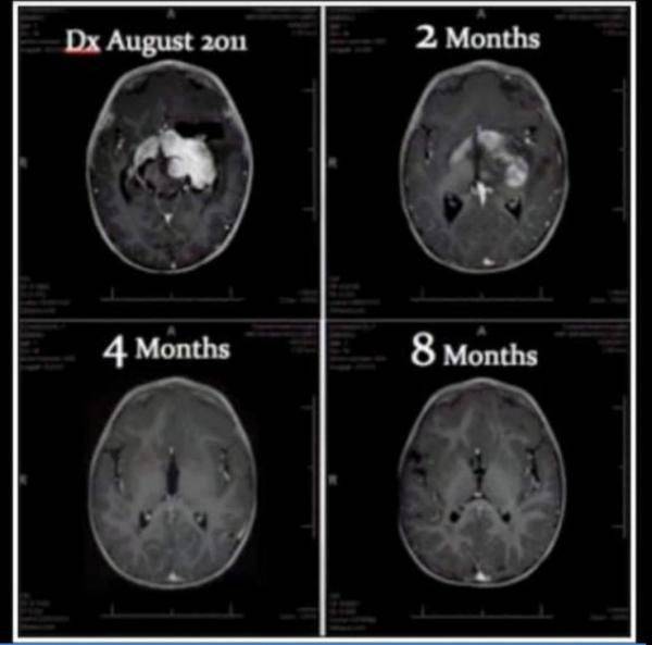 chimio bladder cancer